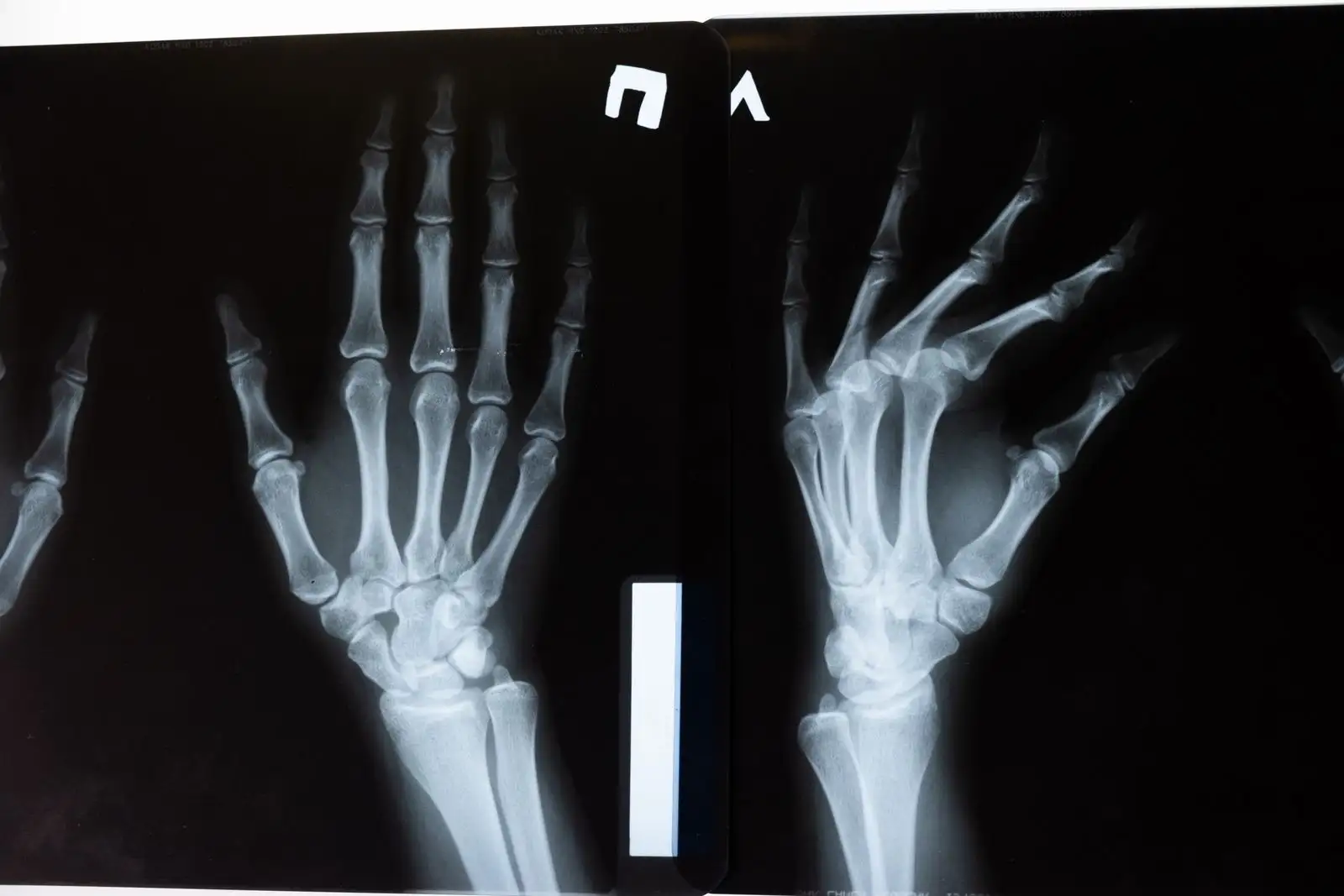 X-ray of both hands, showing the finger joints where osteoarthritis often appears